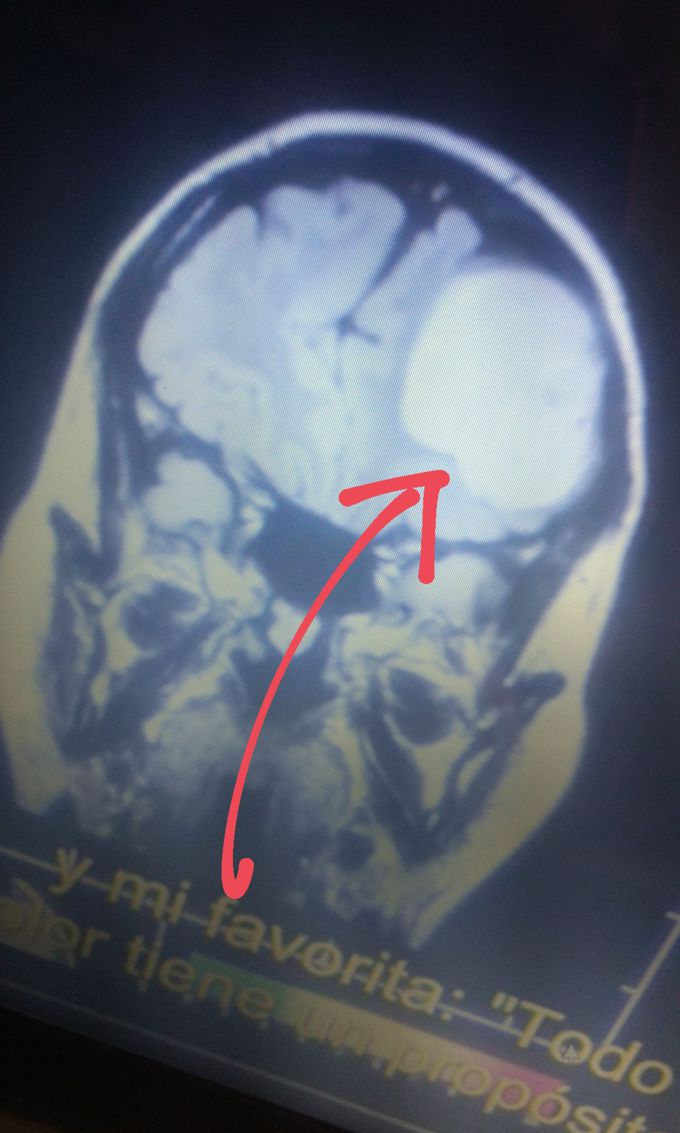 Brain tumor
