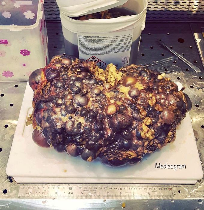 Polycystic kidney disease (PKD)