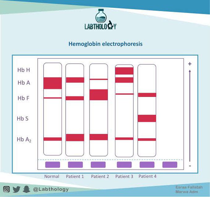 Hemoglobin Electrophoresis