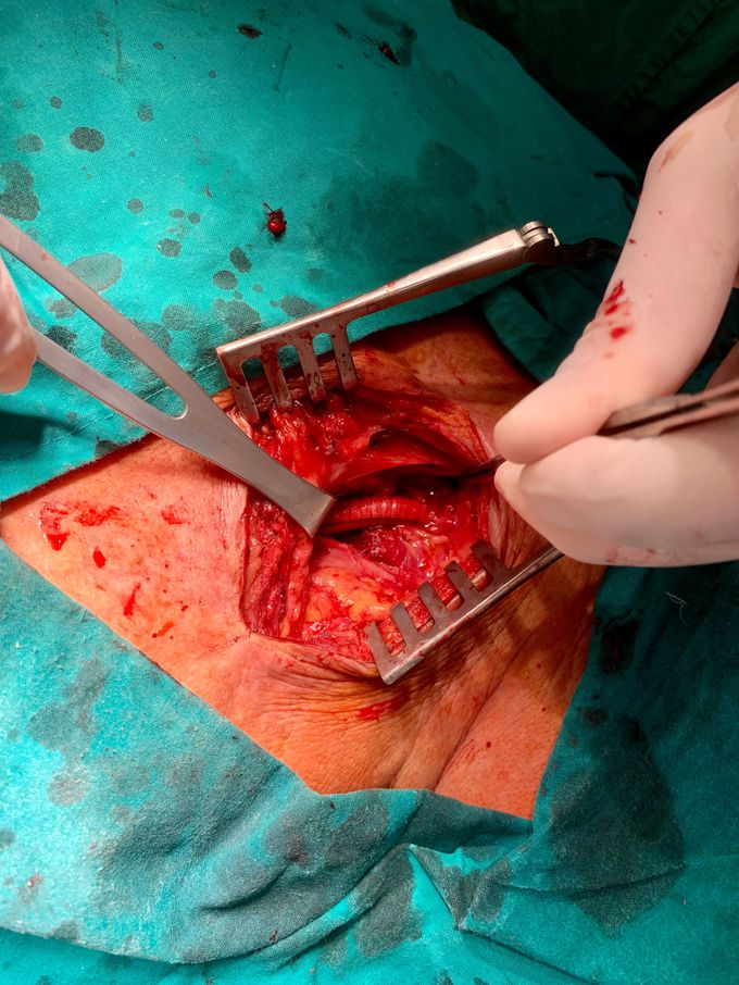 Carotid-subclavian bypass surgery