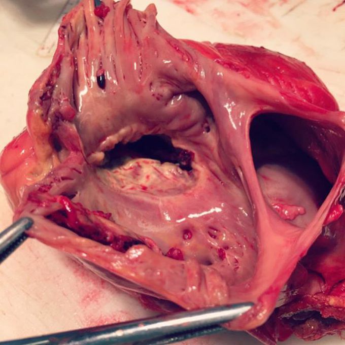 Here is a unique shot of a large atrial septal defect