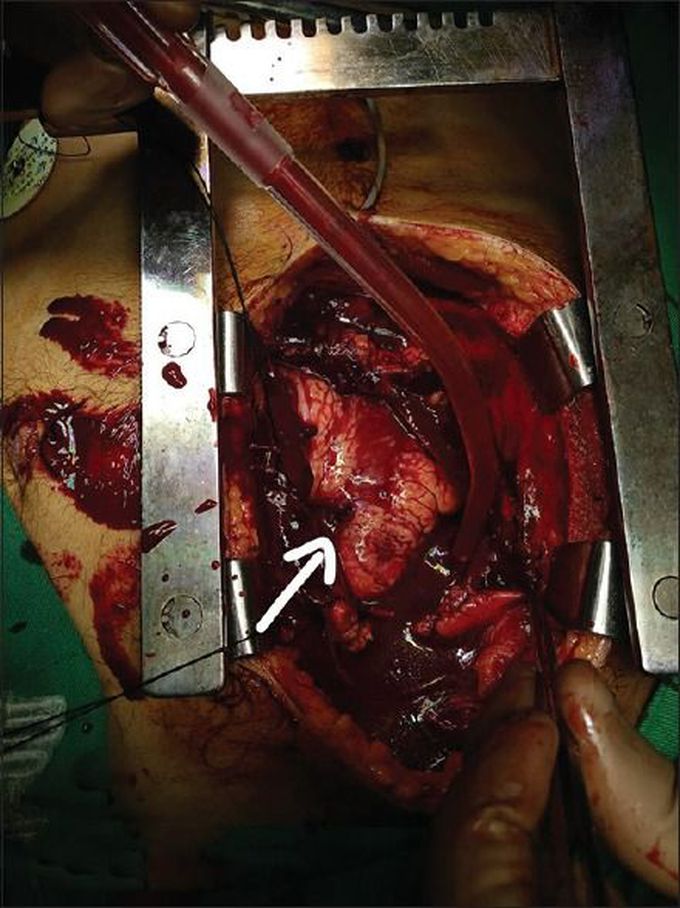 Mending Broken Hearts: A Case Report on Right Ventricle Penetrating Injury