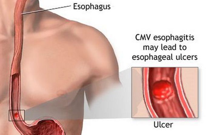 esophagus ulcer