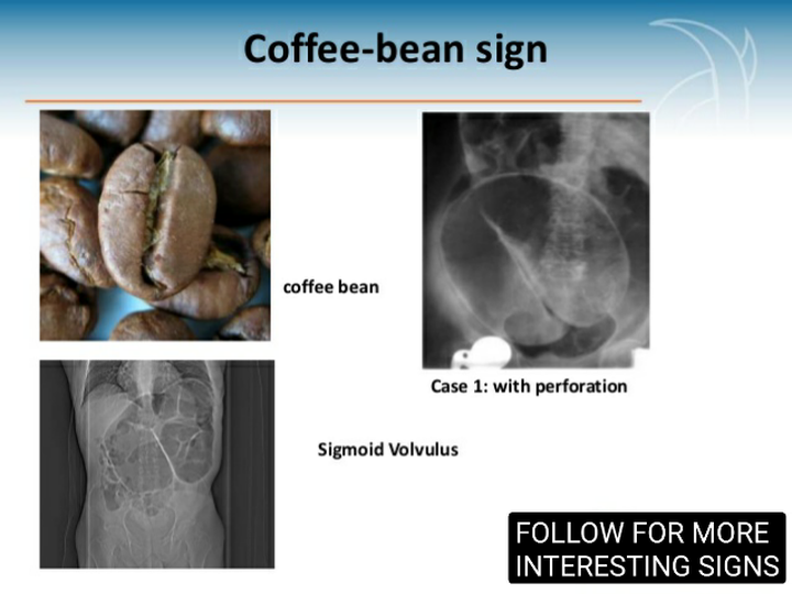 cecal volvulus x ray coffee bean