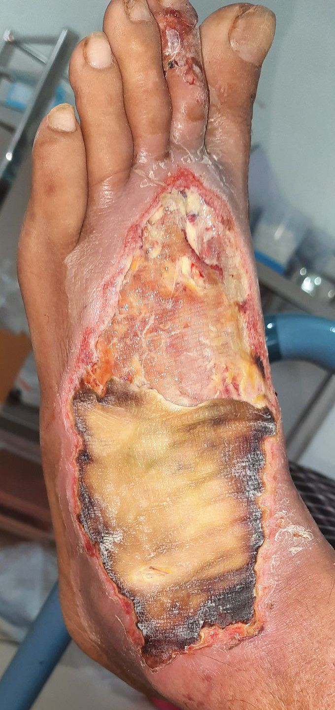 Diabetic foot Ulcer