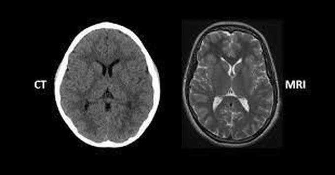 How to differentiate between ct and MRI of brain 