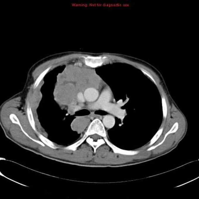 Dysphagia