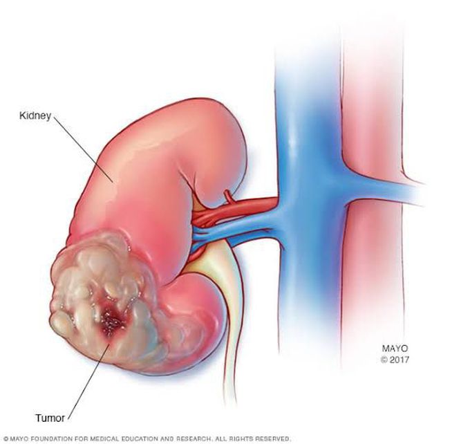 Types of kidney cancers