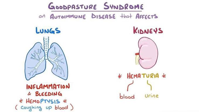 Goodpasture syndrome