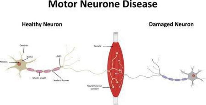 Symptoms progression of motor neuron disease