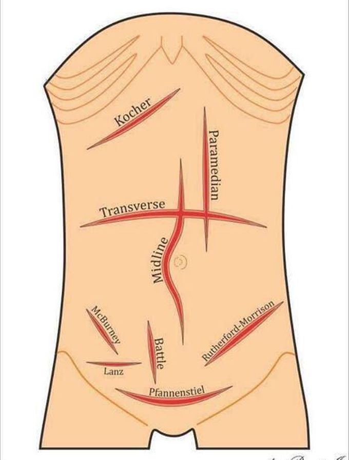 Abdominal Incisions