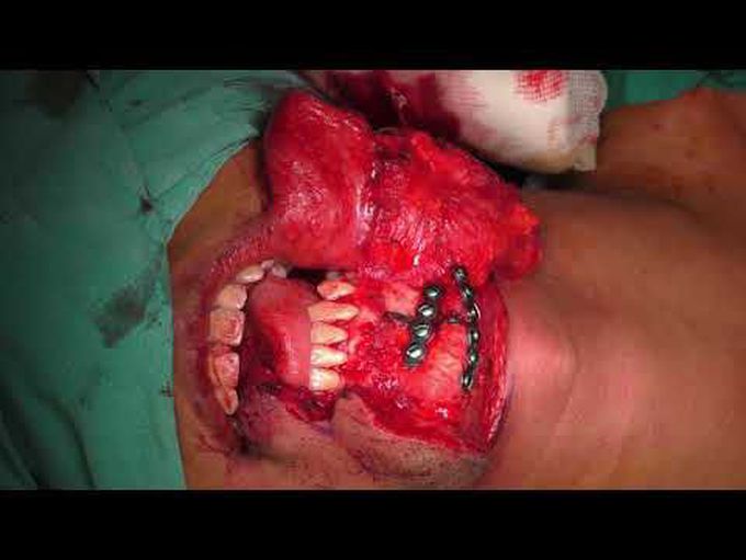 Mandibulotomy approach for glossectomy