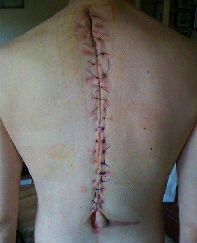 Suturing scar after scoliosis surgery! 