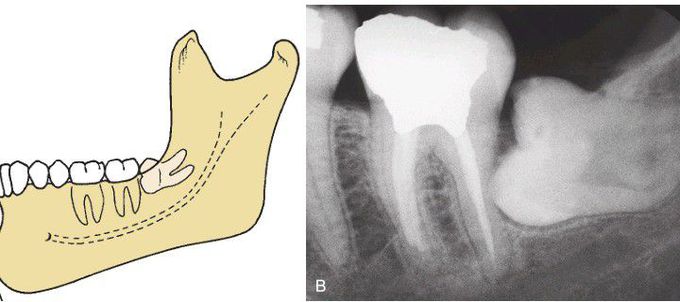 Horizontal impaction