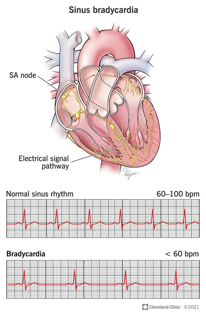 Sinus Bradycardia