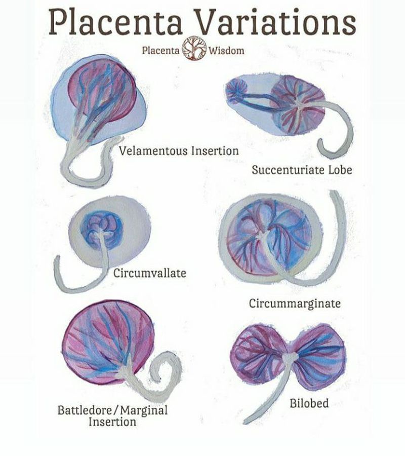 Abnormalities of placenta - MEDizzy