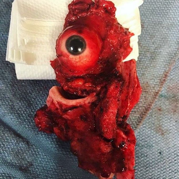 Orbitomaxillary resection !