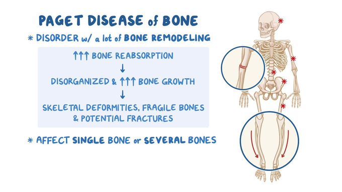 Paget's disease of bone