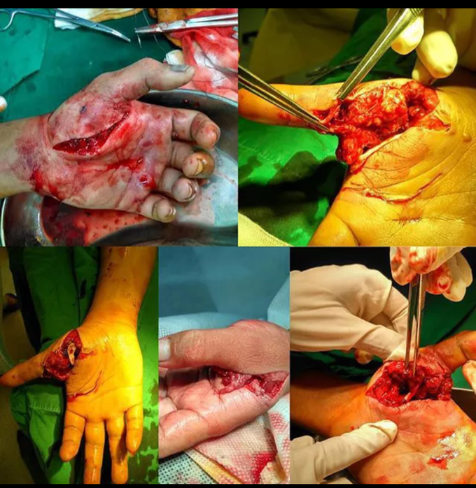 Compound Fracture metacarpals &Tendon