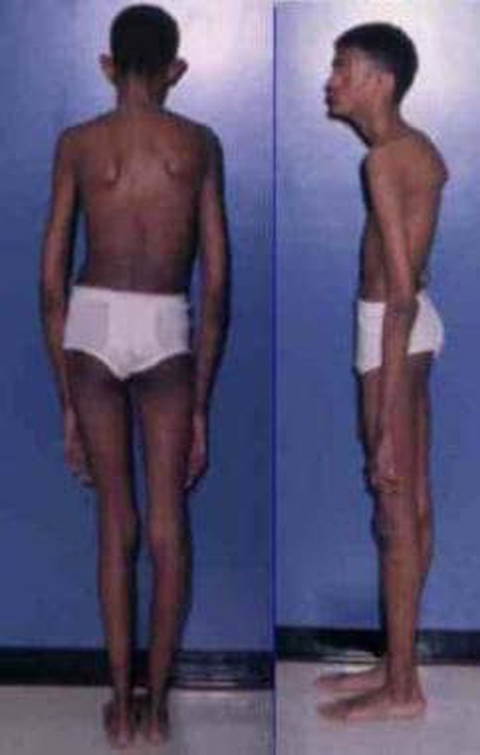 Marfan syndrome