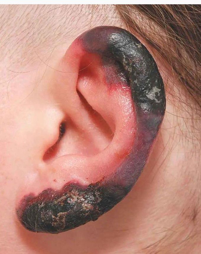 Cutaneous Necrosis on Ear