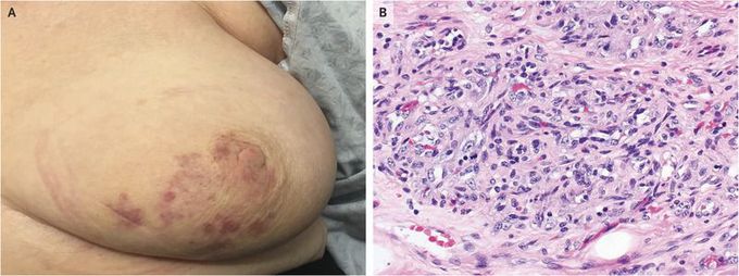 Radiation-Induced Angiosarcoma after Breast-Cancer Treatment