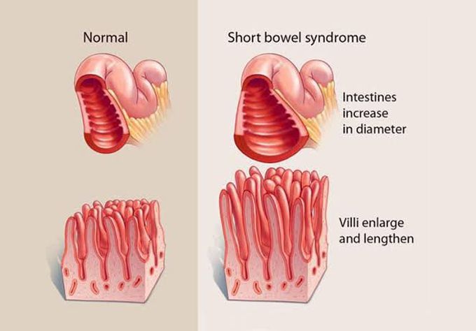 This is the difference between normal and short bowel syndrome