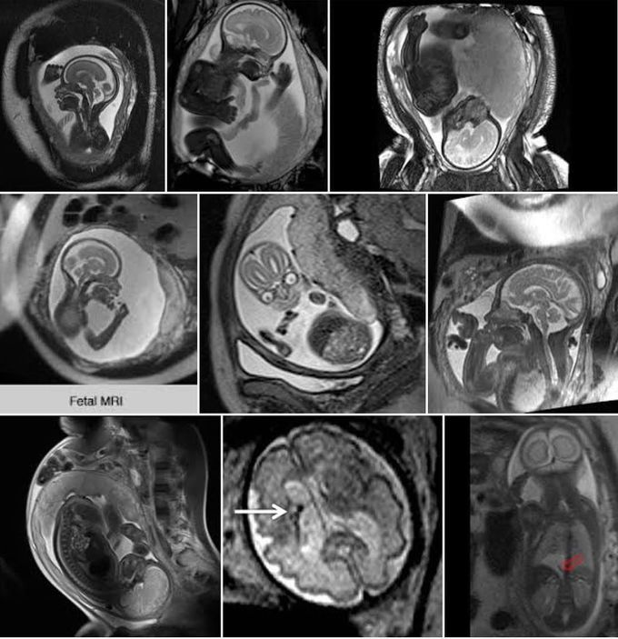 Fetal MRI