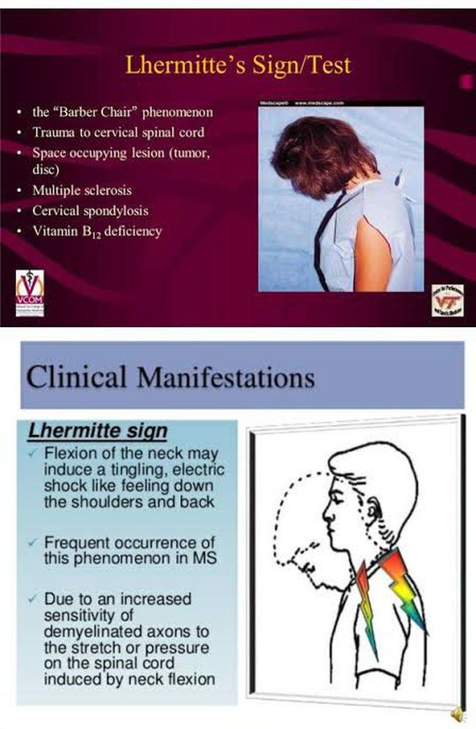 The Lhermitte sign