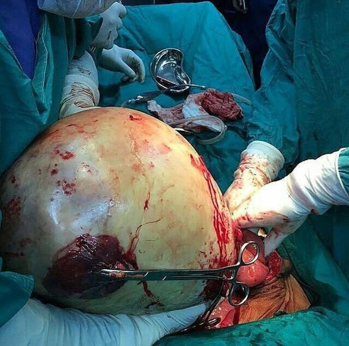 Here we go again- Ovarian Cyst 🏐