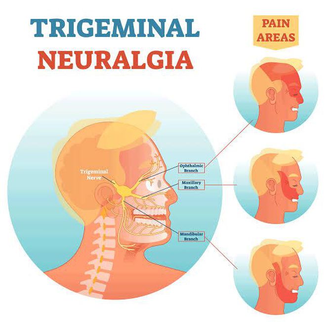 What is trigeminal neuralgia?