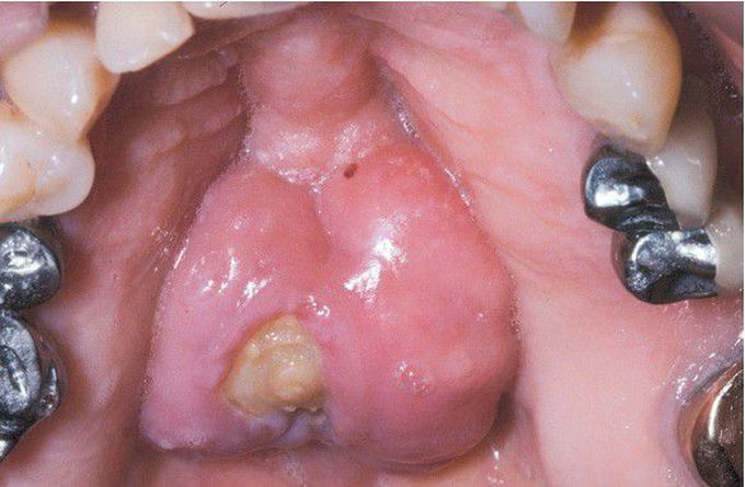 Medication-related Osteonecrosis