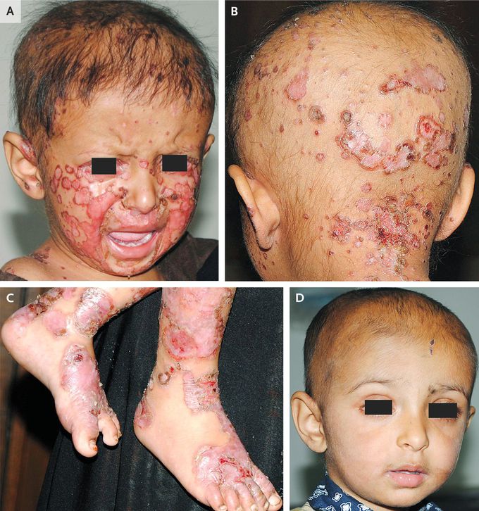 Dietary Zinc Deficiency–Associated Dermatitis in a Child