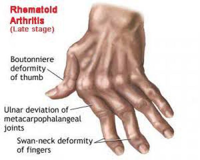 Rheumatoid Arthritis