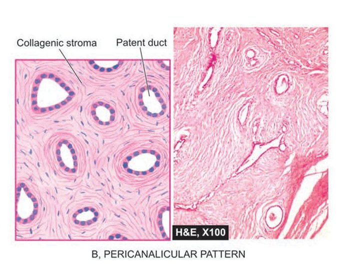 Fibroadenoma