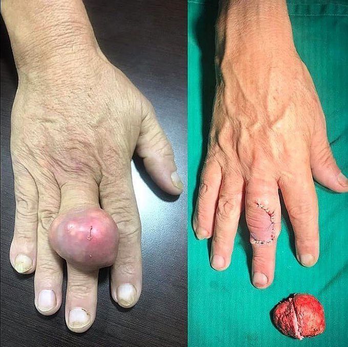 Removal of a Gouty Tophus!