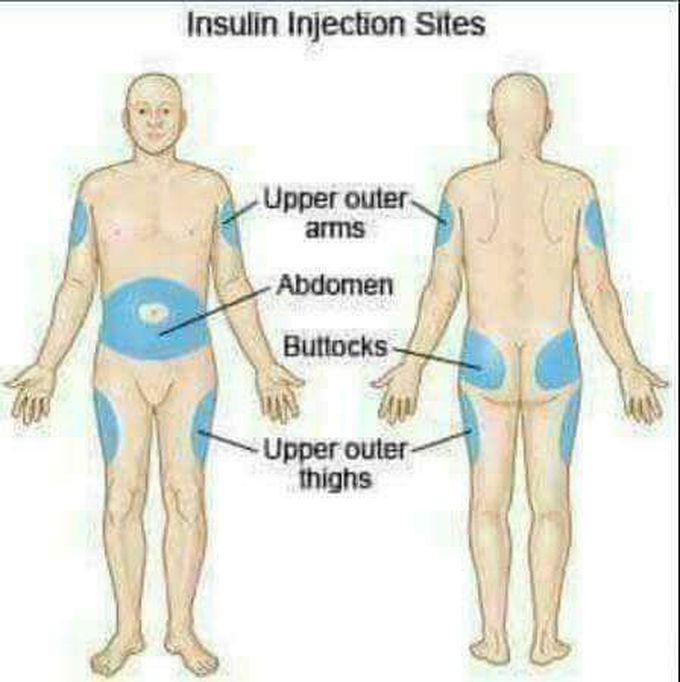 Diabetes
