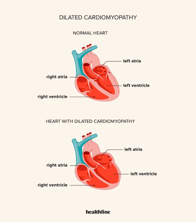 Dilated cardiomyopathy