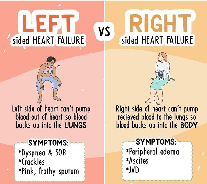 Left Sided Vs Right Sided Heart Failure