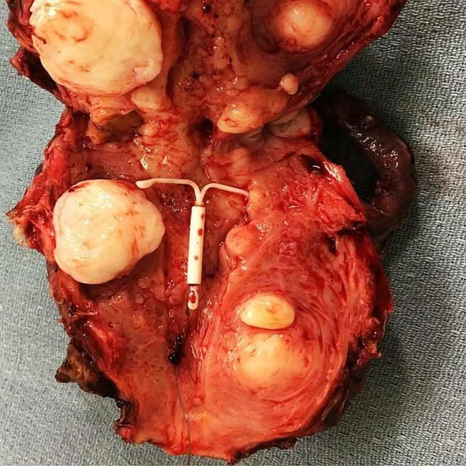 Multiple uterine myomas of different sizes! Who knows what’s the device at the center?