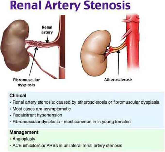 Diagnostic test for Renal artery Stenosis is Renal Angiography to check the lumen of blood vessel