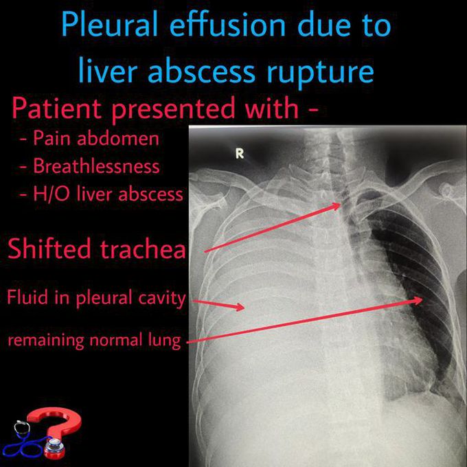 Pleural Effusion