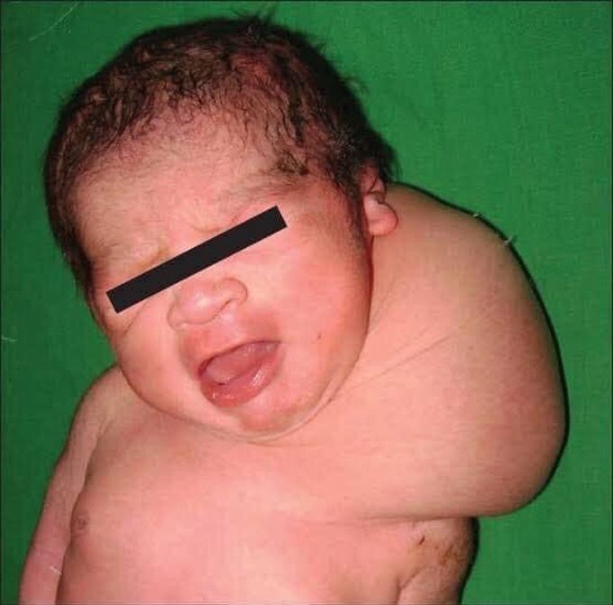 Cystic Hygroma