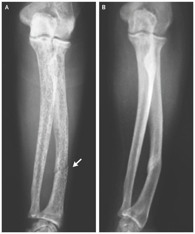 Radial Fracture Due to Parathyroid Carcinoma