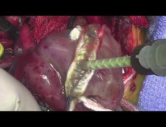 Norwood and Batista Procedure in Neonatal Dilated Cardiomyopathy