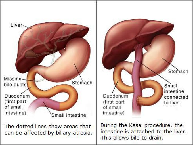 Kasai procedure