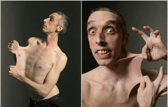 Rubber man syndrome