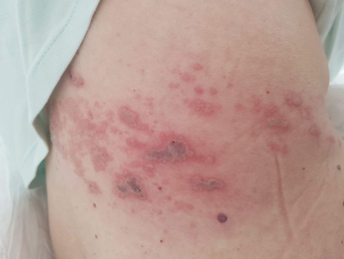 Development of Herpes Zoster blisters on the torso