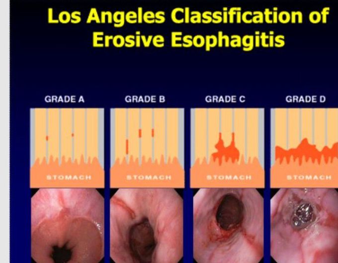Classification of Erosive Esophagitis
