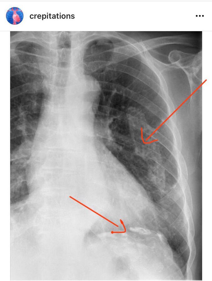 Asbestosis - Lung x ray